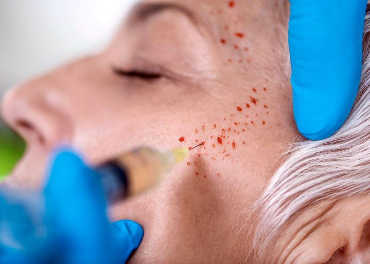 PRP Face Cosmetics Injecting. Beautiful mature woman receives Platelet Rich Plasma face injection treatment for reducing wrinkles. Anti-aging concept. ; Shutterstock ID 1266720283; Purchase Order: rs.com